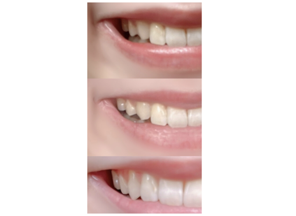 肝心のホワイトニング効果は？