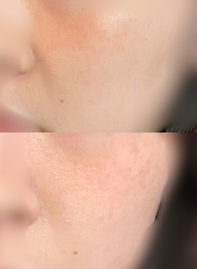 リフトアップ効果は？