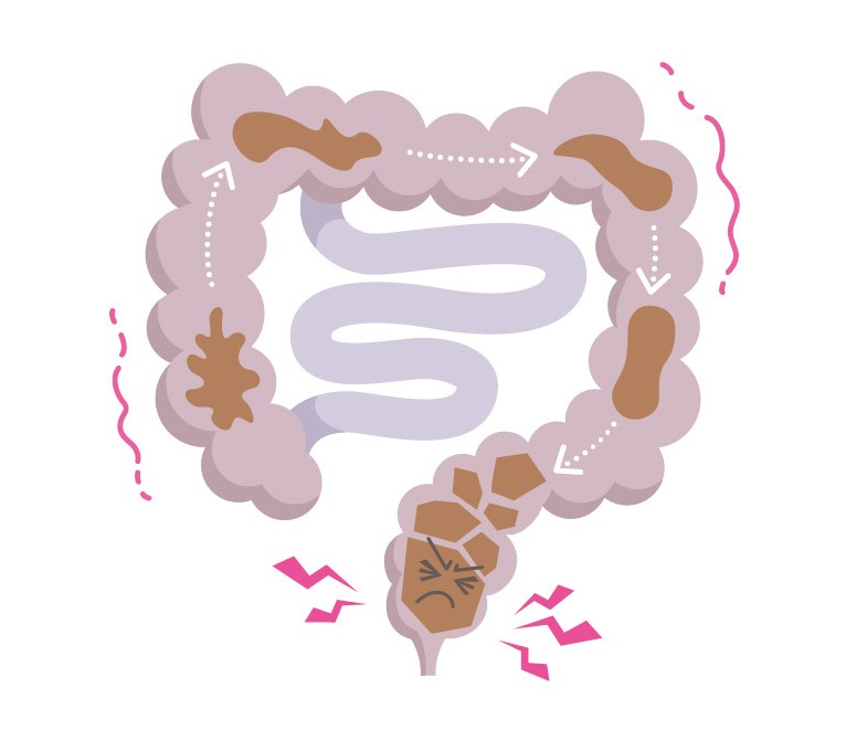 便やガスが腸に溜まっている