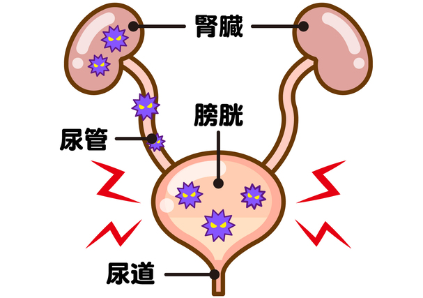 女性に多い膀胱炎とは