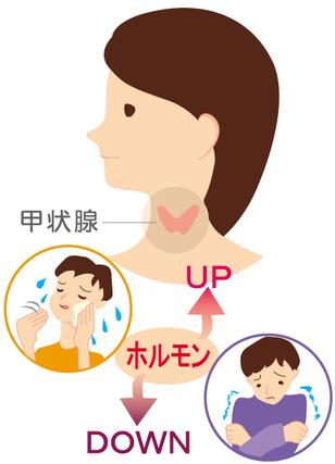 バセドウ病とは